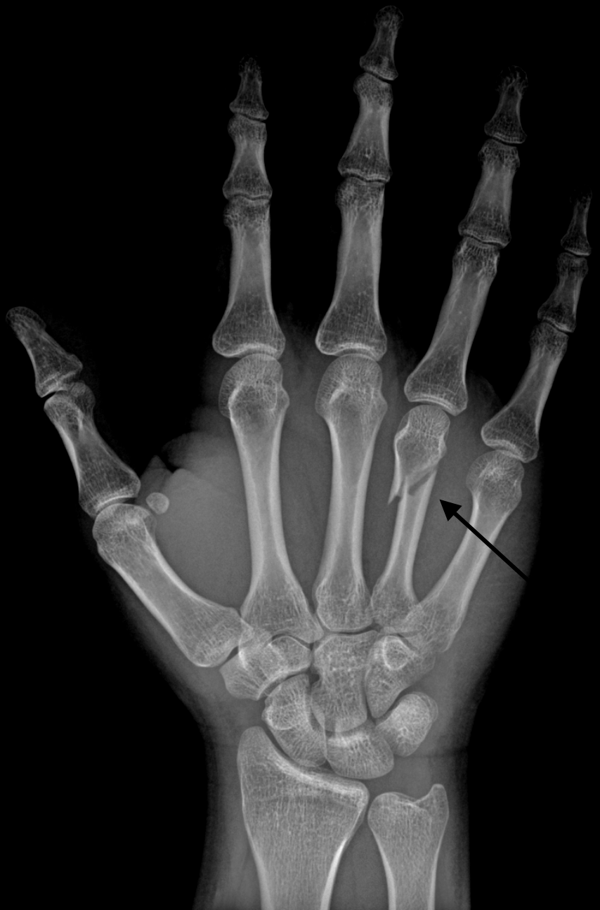neck_fracture_of_the_fourth_metacarpal_bone.png